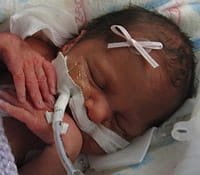 Kristina needed a tumor removed before she was born.